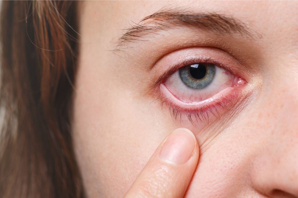 What is Adenoviral Conjunctivitis? Symptoms and Treatment