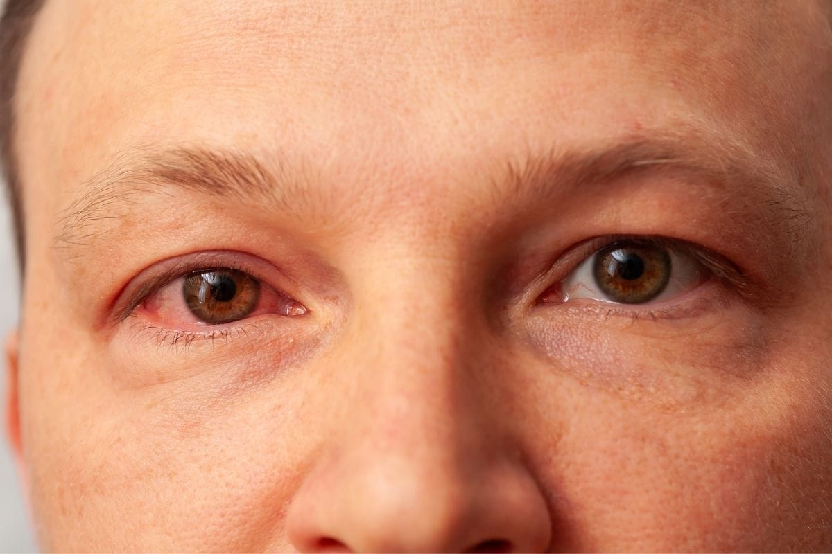 What is Eye Migraine? Symptoms, Causes and Treatment Methods