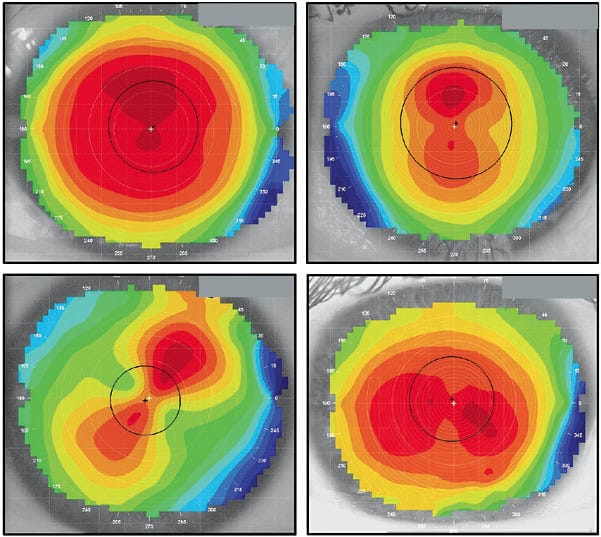 What is Corneal Topography (Pentacam)? Why is it done before laser surgery?