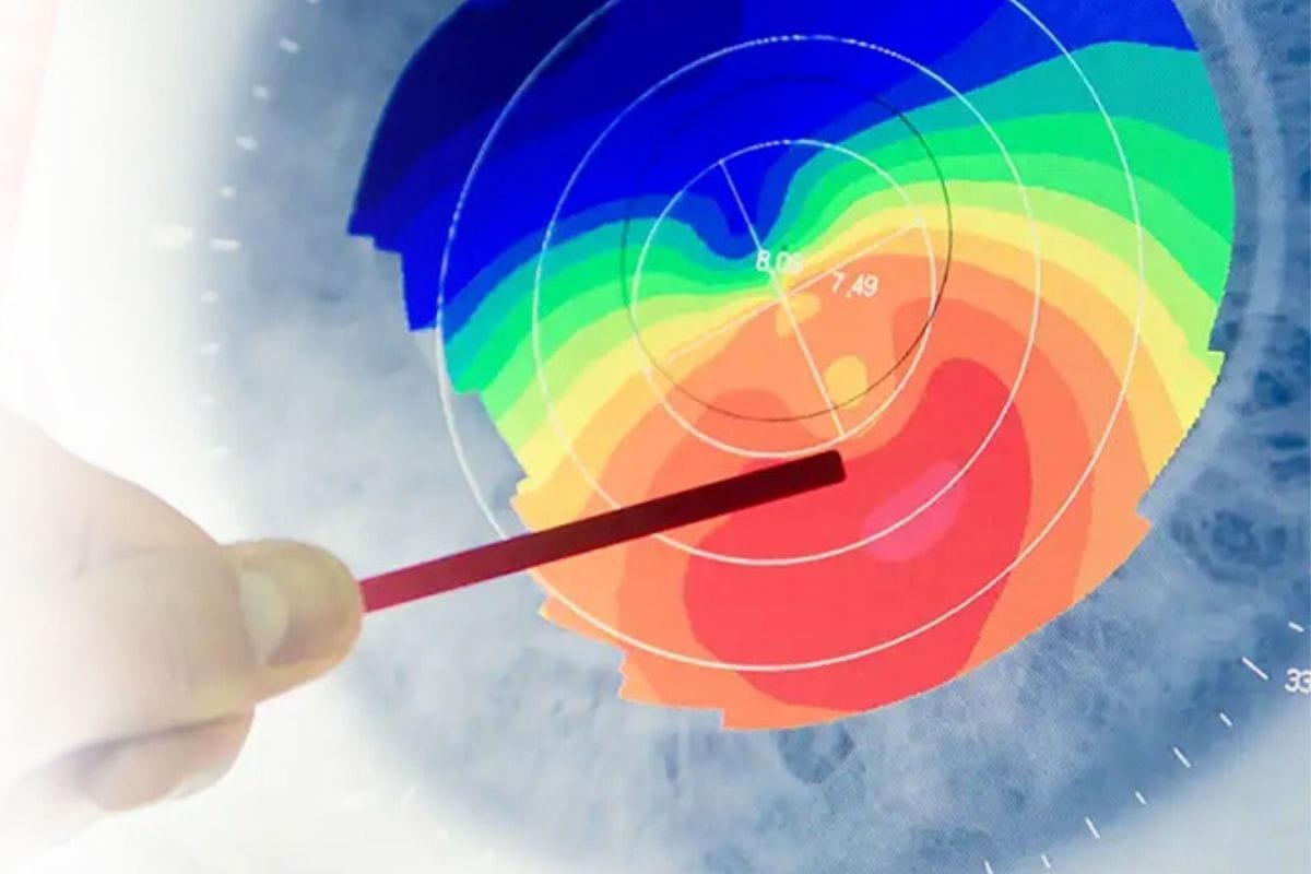 What is Laser Topography? Cornea Mapping Test
